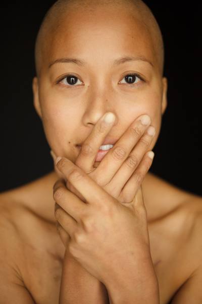 Photograph Robert Houser Cancer Patient on One Eyeland