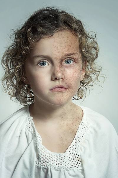 Photograph Lee Howell Skin Damage Awareness on One Eyeland