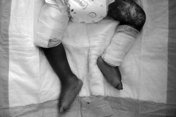 Photograph Wayne Chinnock Malnutrition In Haiti on One Eyeland