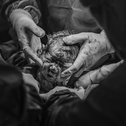 Caesarean section-Fei Li-gold-black_and_white-2776